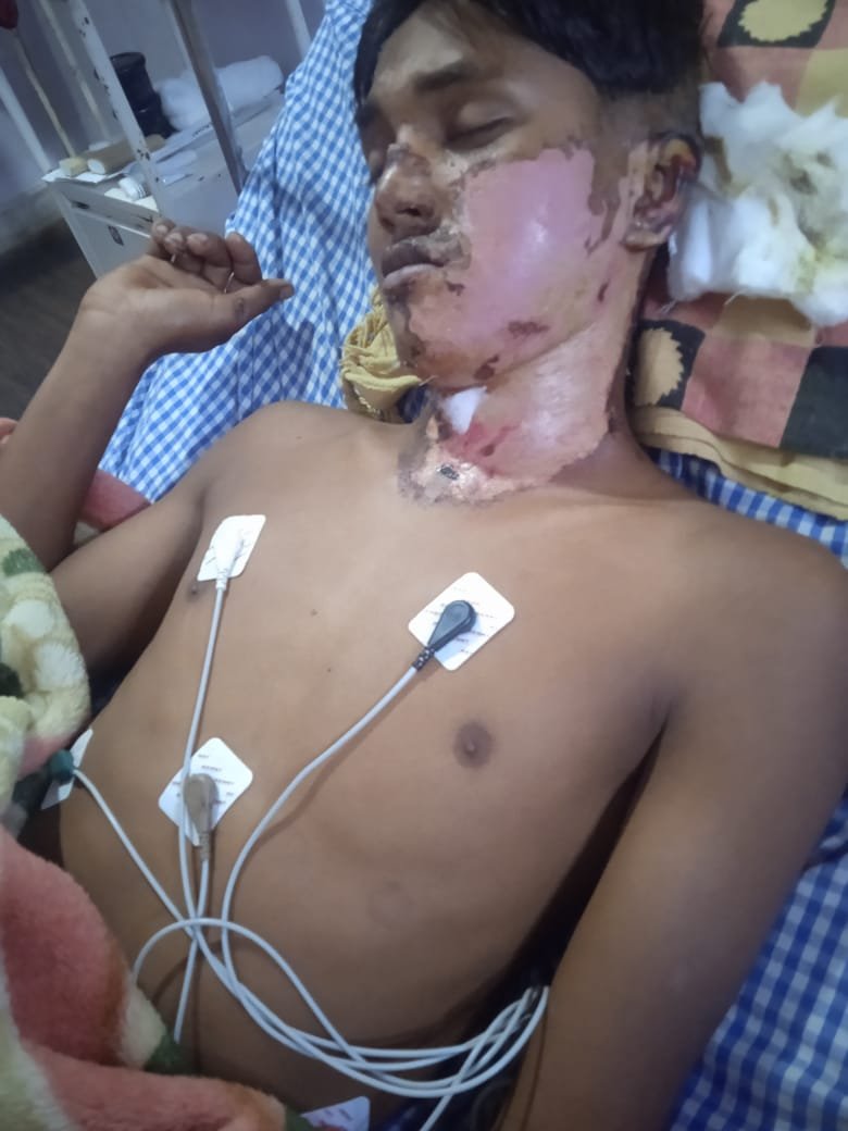 विद्युत तार के चपेट में आकर झुसला हुआ व्यक्ति